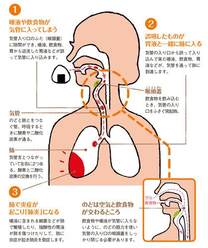 誤飲の図解